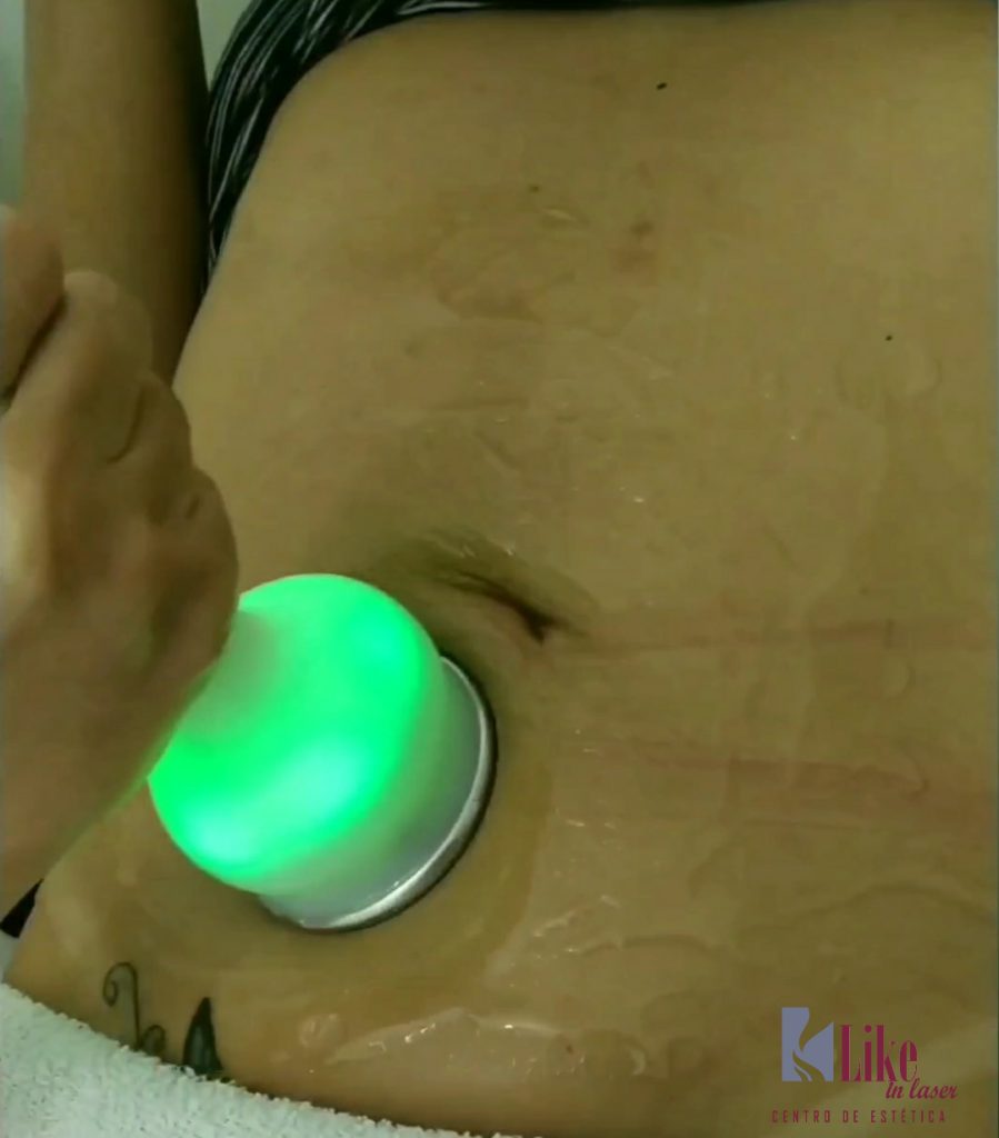 Radiofrequência (facial e corporal)